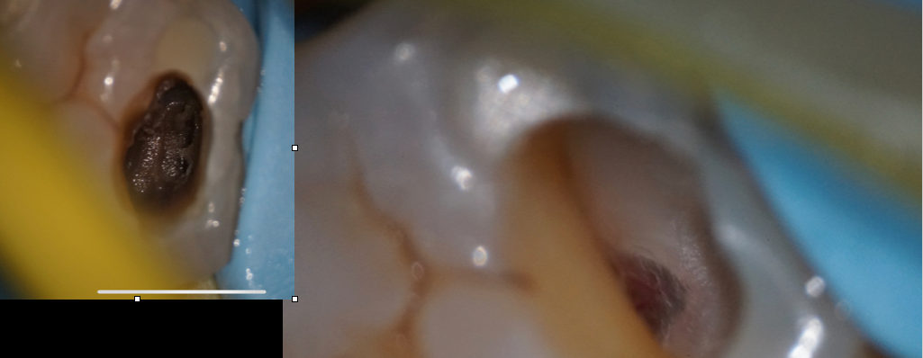 Deep caries removal, pulp exposure