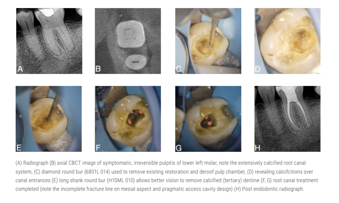 Komet Endo access kit by Prof Patel