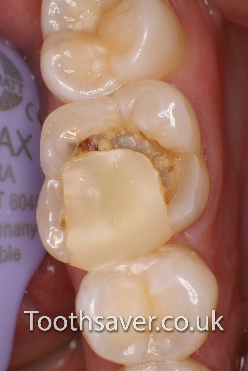 KP Dental Intra-Oral Camera | USB Camera for Patient Communication