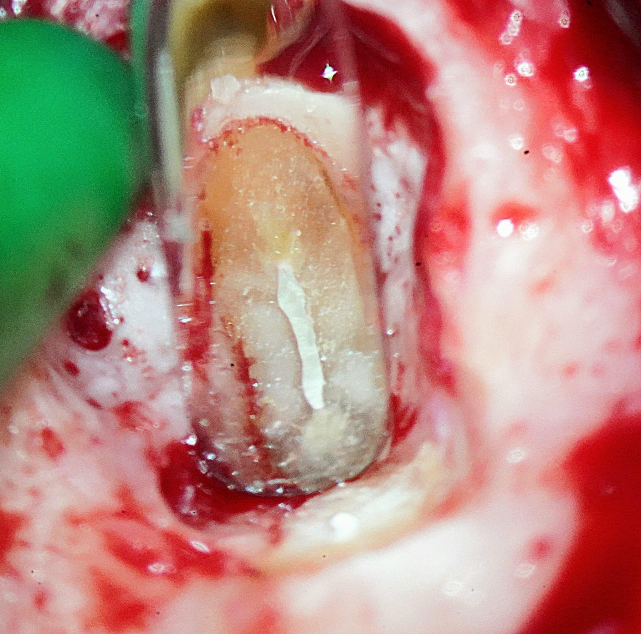 One-Fil PT Bioceramic Endodontic Putty | Premixed Tricalcium Silicate Material Putty and Injectable