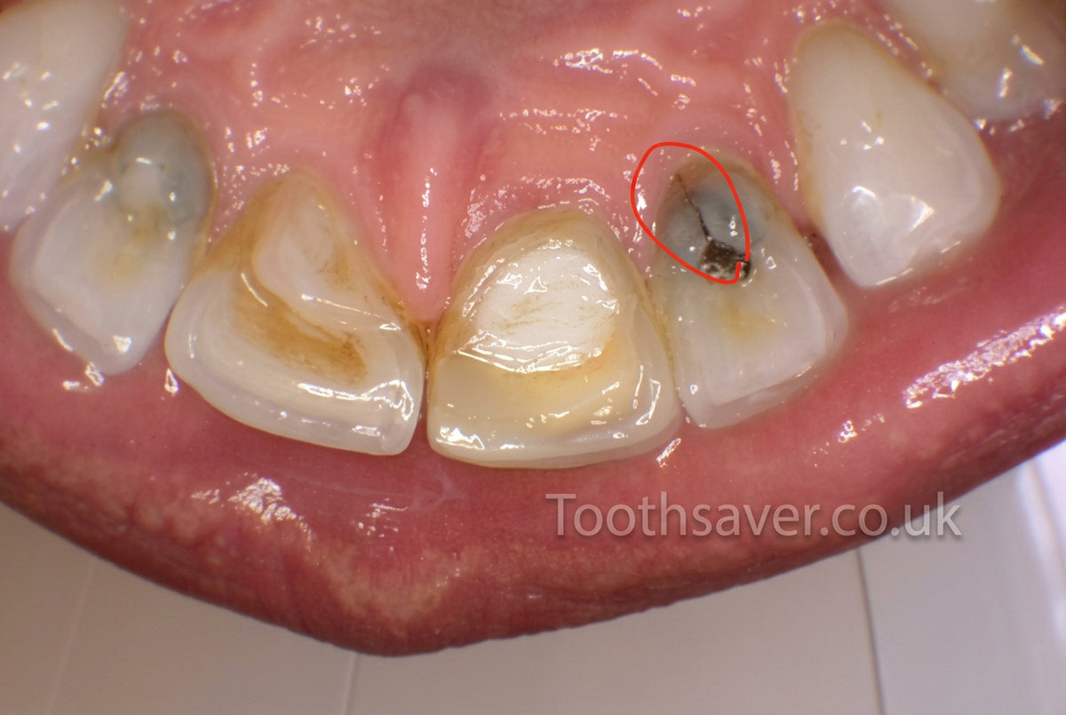 KP Dental Intra-Oral Camera | USB Camera for Patient Communication