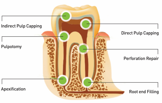 One-Fil PT Bioceramic Endodontic Putty | Premixed Tricalcium Silicate Material Putty and Injectable