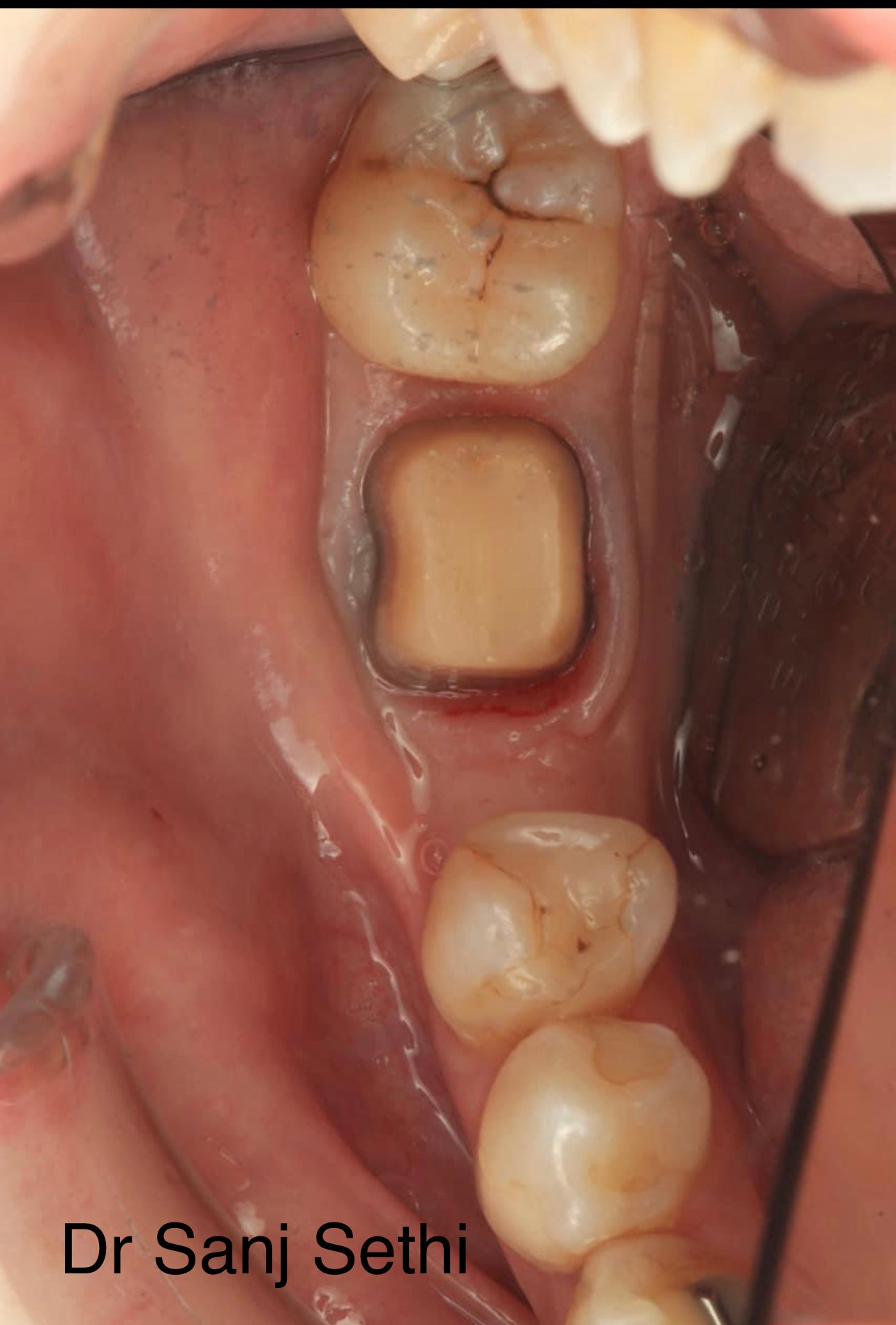 Sure-Cord Plus- Knitted retraction cord