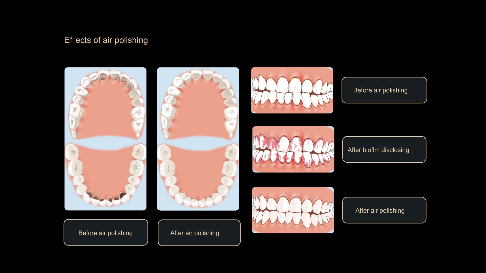 AP-H Dental Air Polisher- Supra-gingival only