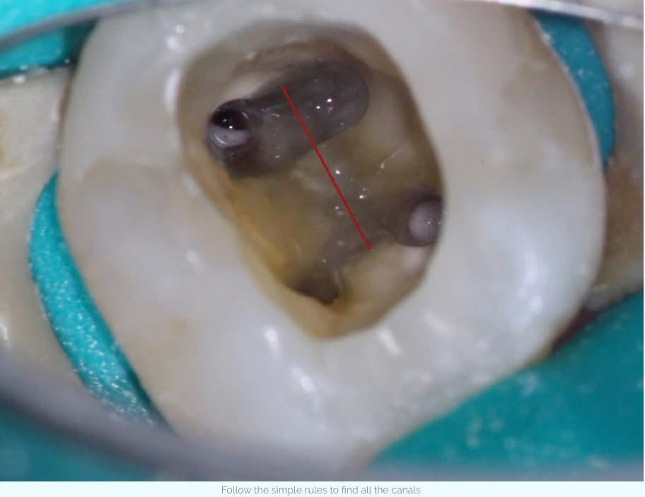 Finding canals, mb2 and other challenging canals