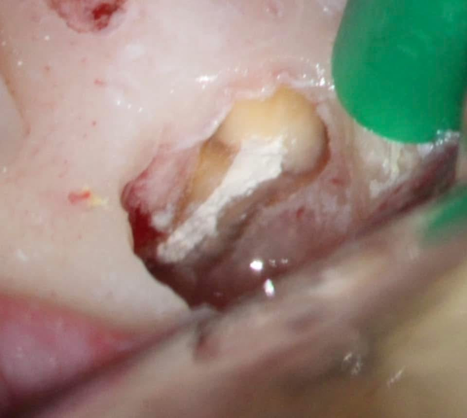 Endodontic microsurgery