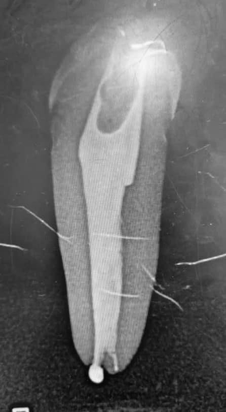 One-Fil PT Bioceramic Endodontic Putty | Premixed Tricalcium Silicate Material Putty and Injectable