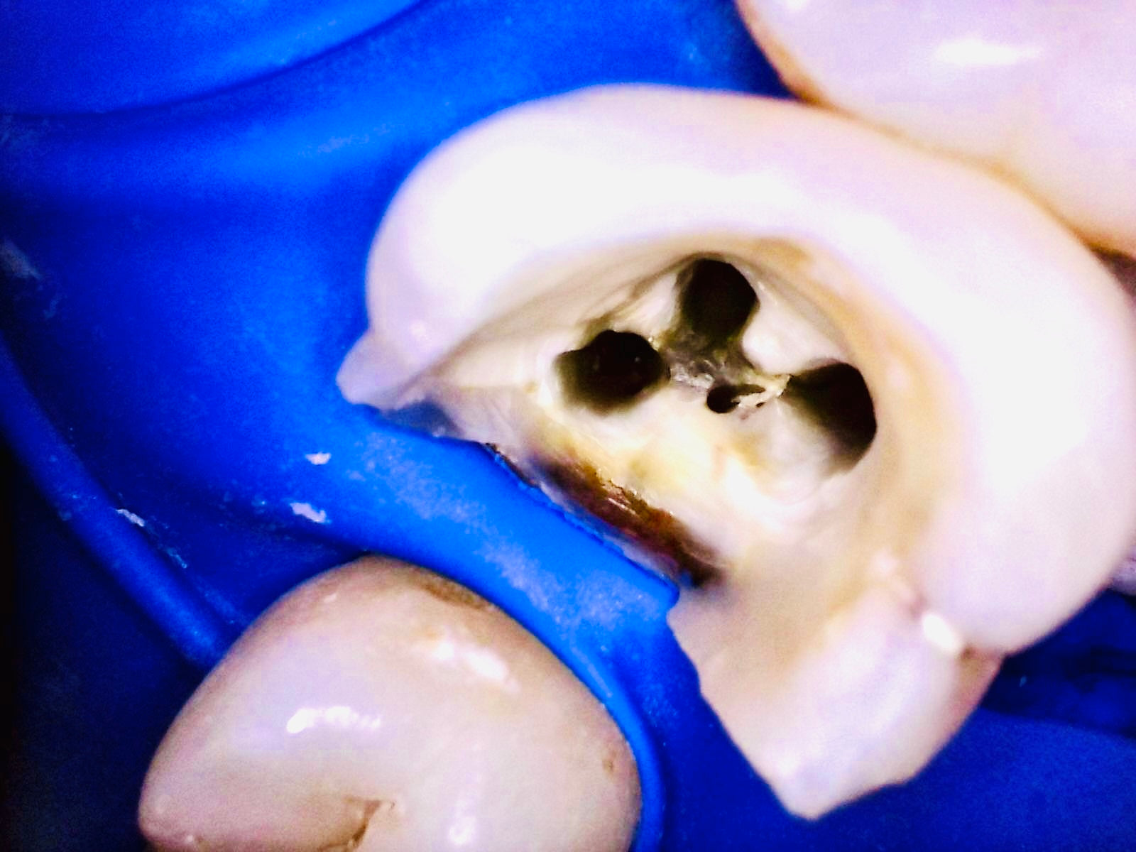 Intra-oral camera