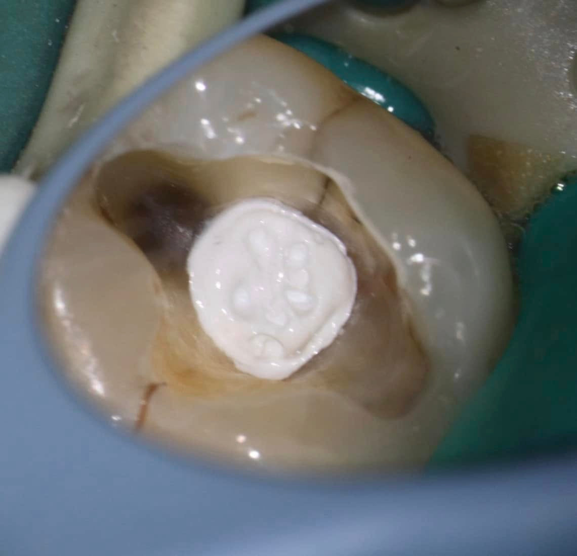 One-Fil PT Bioceramic Endodontic Putty | Premixed Tricalcium Silicate Material Putty and Injectable