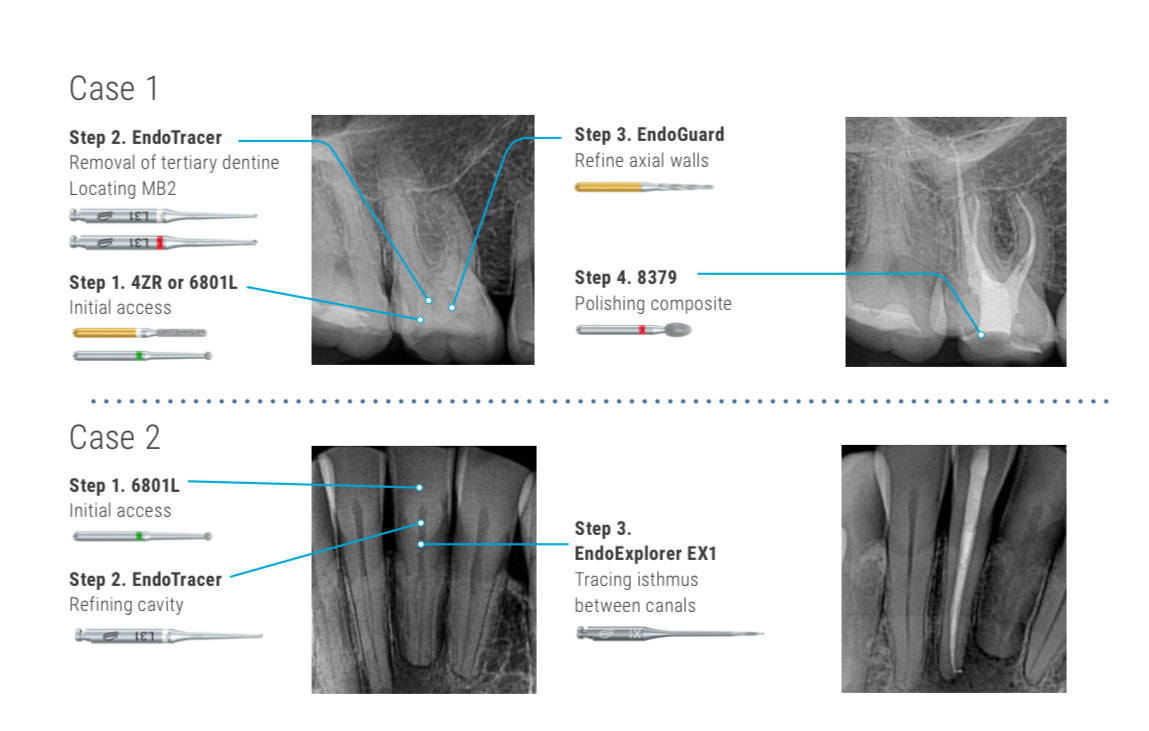 Komet Endo access kit by Prof Patel