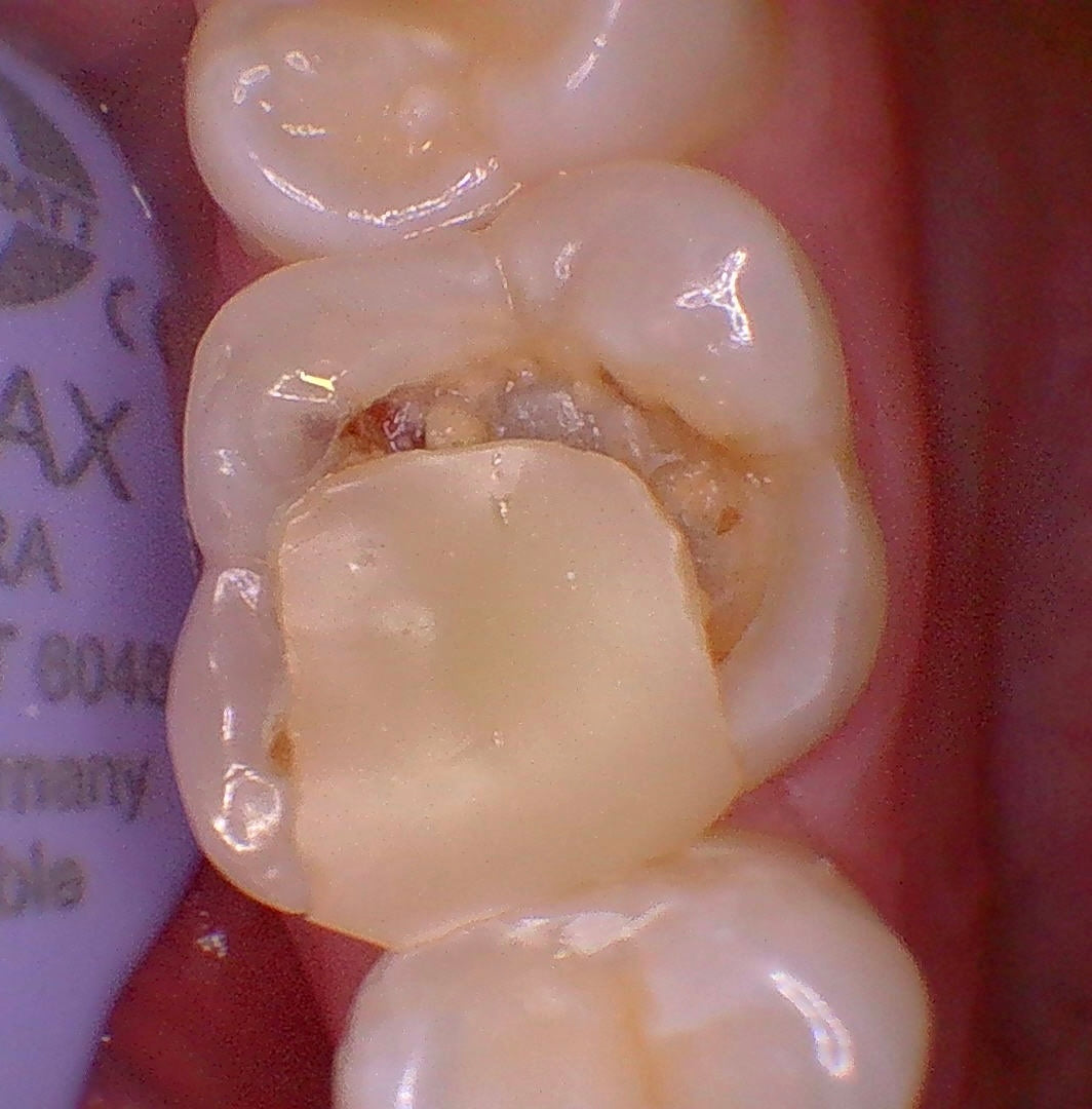 Intra-oral camera