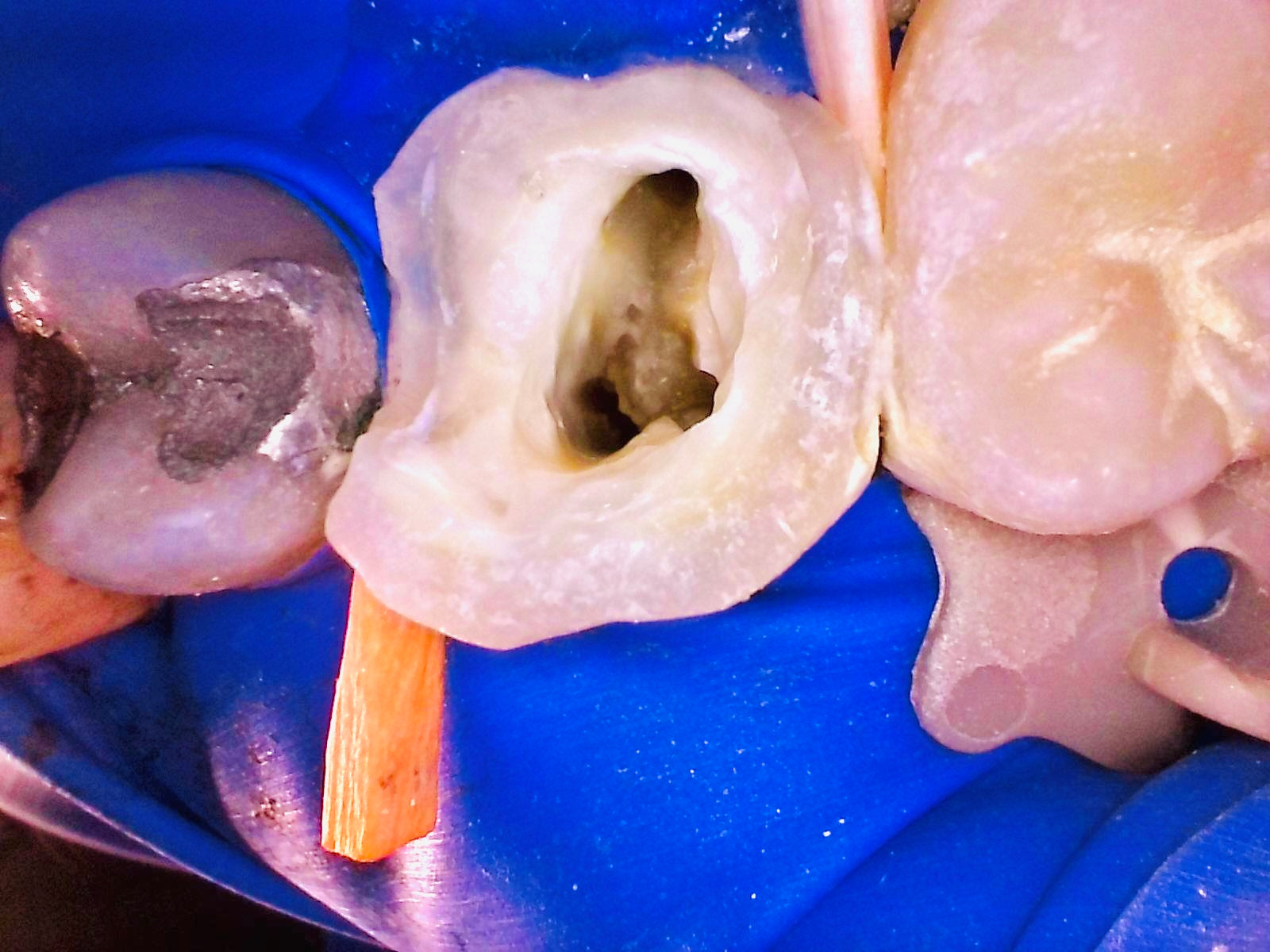 Intra-oral camera