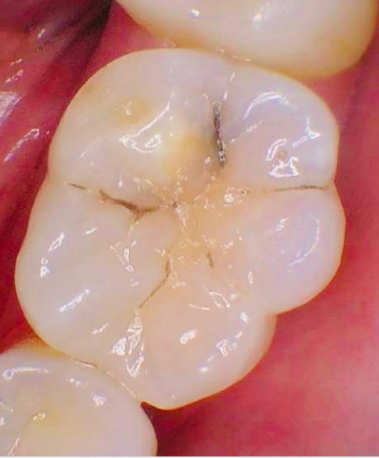 Intra-oral camera