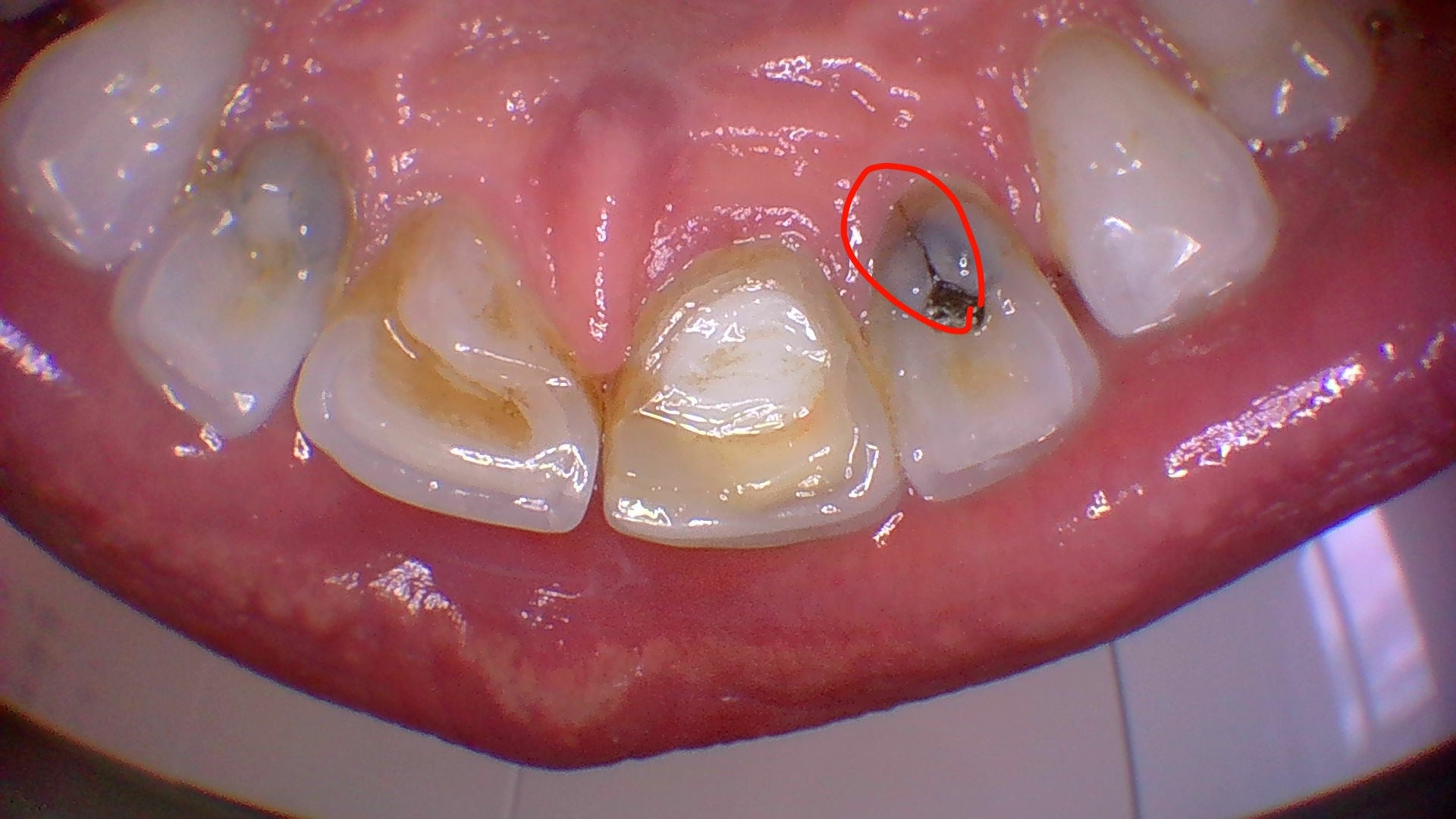 Intra-oral camera