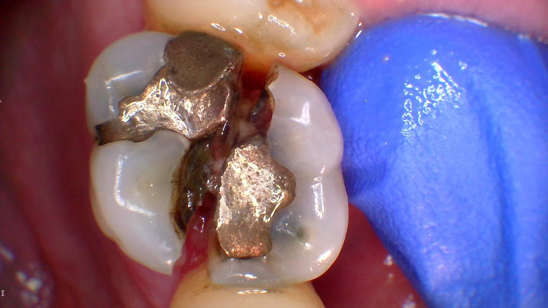 Intra-oral camera