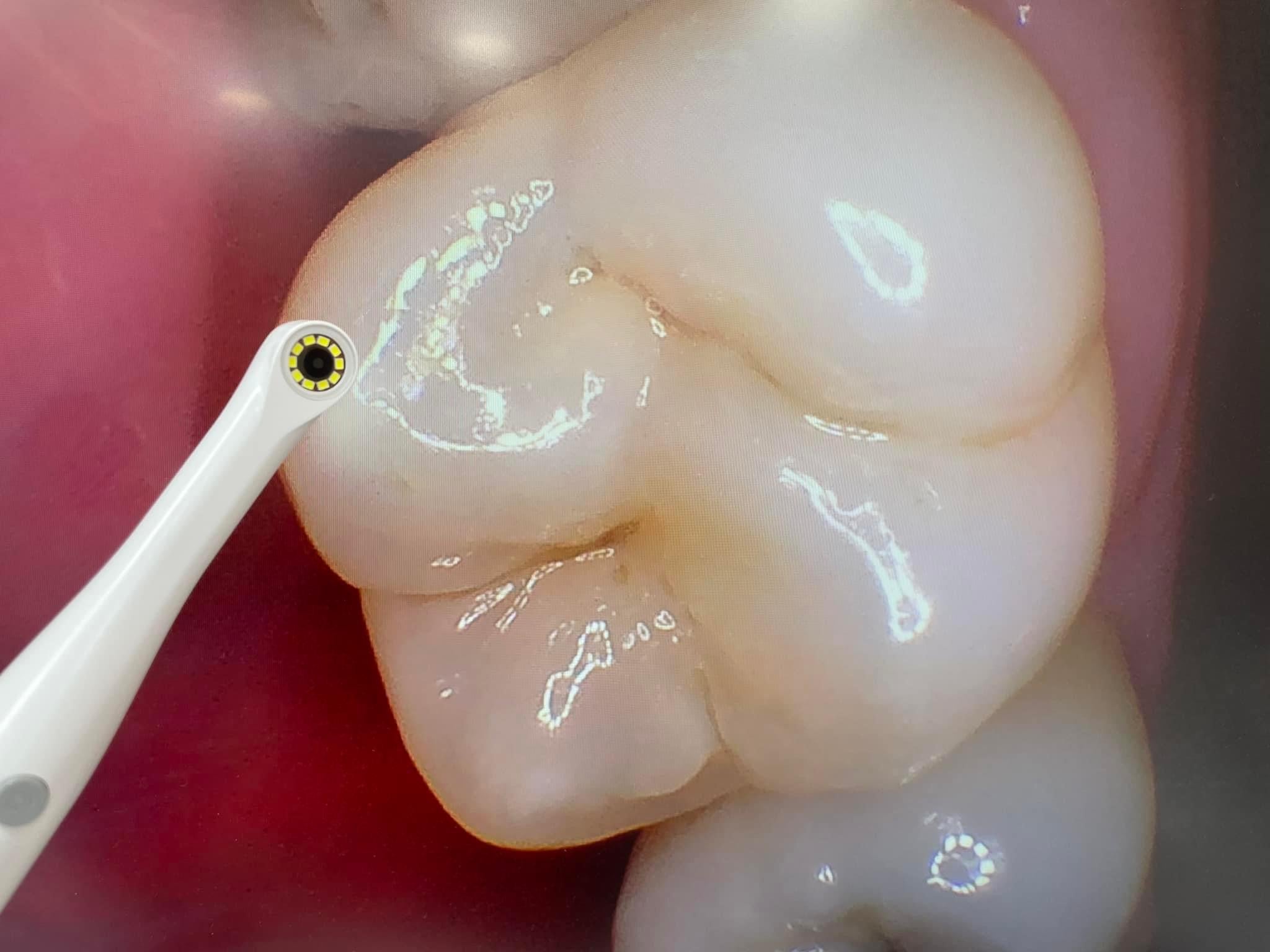Intra-oral camera