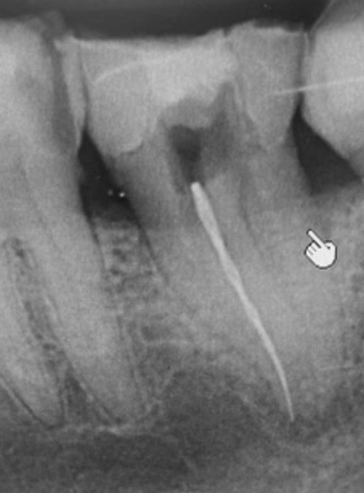 FIMC- Fractured Instrument Management Course: You don't always have to take them out.