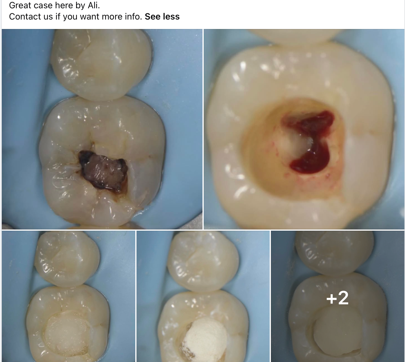 One-Fil PT Bioceramic Endodontic Putty | Premixed Tricalcium Silicate Material Putty and Injectable