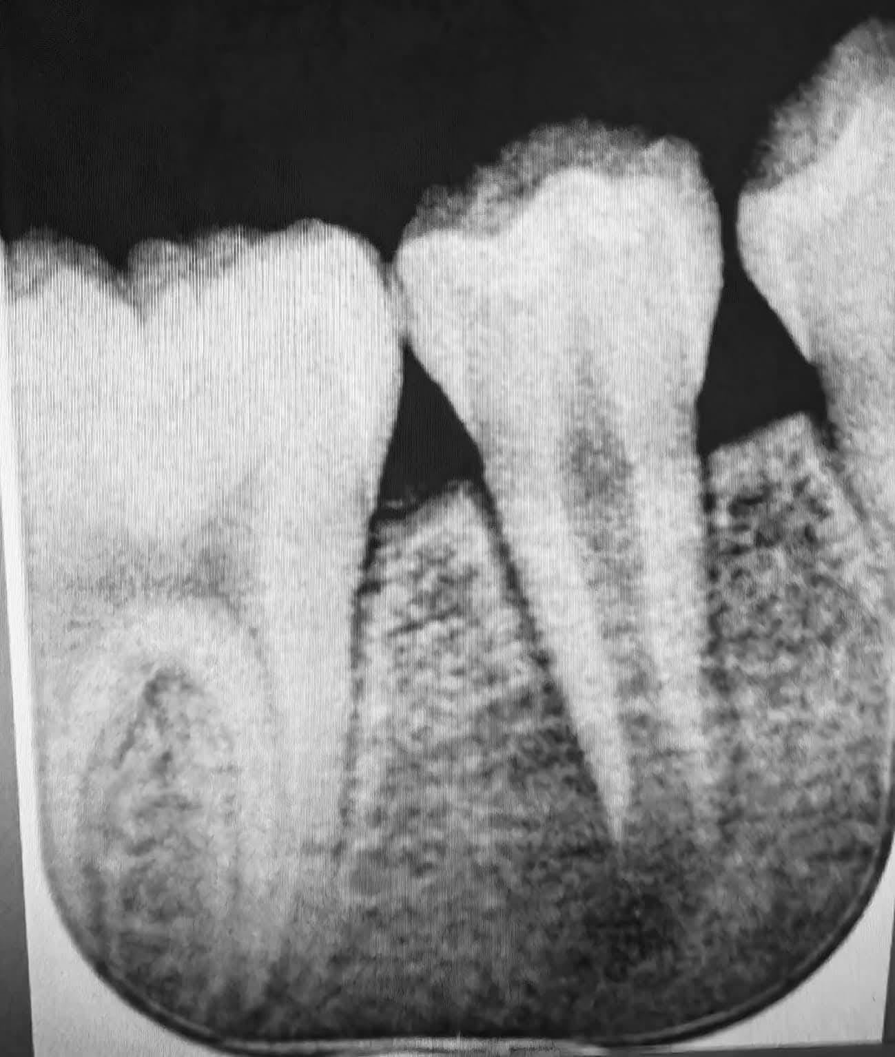 Webinar on Regenerative Endodontics with Dr Nicolai Orsteen